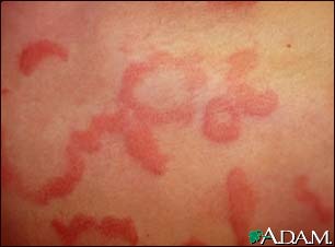 urticaria urticaria